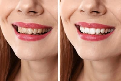 Teeth Whitening